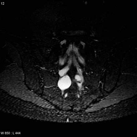 Tarlov cyst | Radiology Reference Article | Radiopaedia.org