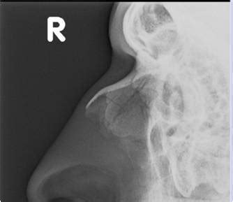 Nasal Bone Fracture X Ray