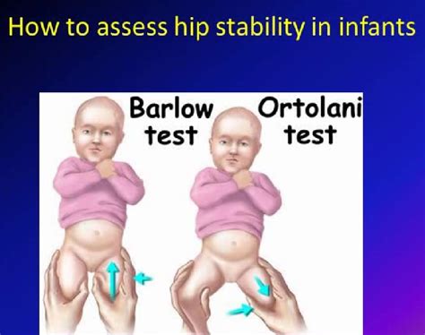 Developmental Dysplasia of the Hip — OrthopaedicPrinciples.com