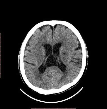 Cavum velum interpositum cyst | Radiology Case | Radiopaedia.org