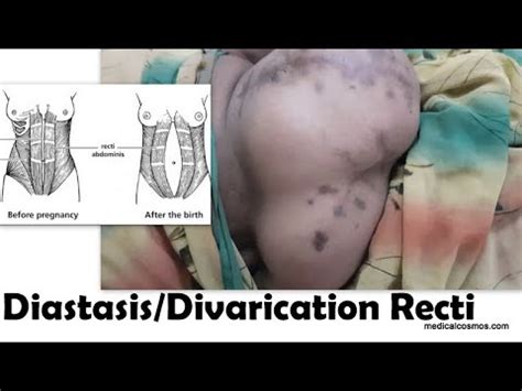 Recti Divarication/Diastasis - Abdominal #Hernia - YouTube