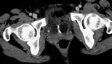 Ureterocele Imaging: Practice Essentials, Radiography, Computed Tomography