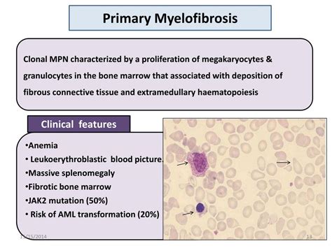 PPT - Myeloproliferative Neoplasms PowerPoint Presentation, free ...