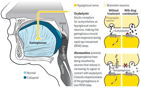 JCM | Free Full-Text | Obstructive Sleep Apnea: Emerging Treatments Targeting the Genioglossus ...