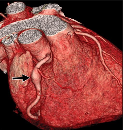 Coronary Artery Aneurysms and Ectasia: Role of Coronary CT Angiography ...