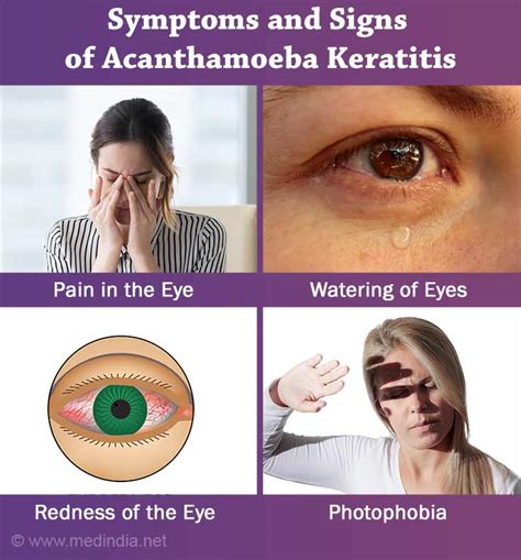 Acanthamoeba Keratitis - Symptoms, Signs, Diagnosis & Treatment