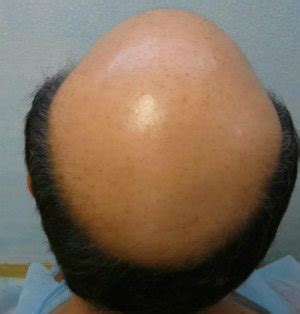 Dr. Umar Hair Transplant – Hair Restoration News Worldwide