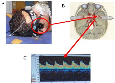 Transcranial Doppler Ultrasound