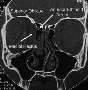 Prevention and Management of Orbital Hematoma | Ento Key