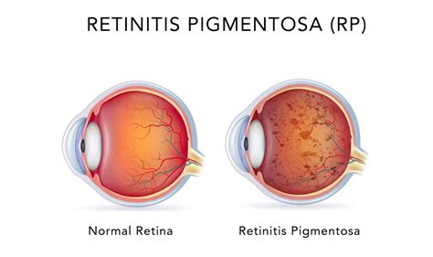 Retinitis Pigmentosa - AcuVision Acupuncture!