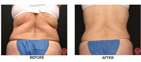 non-surgical body shaping | Allentown PA