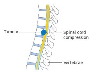 Spinal cord compression - wikidoc