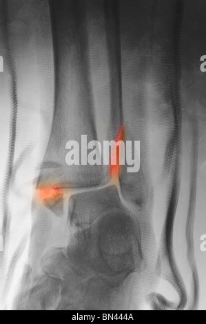 bimalleolar ankle fracture in a fiberglass splint Stock Photo - Alamy