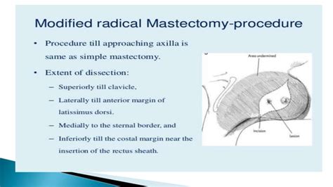 Modified radical mastectomy