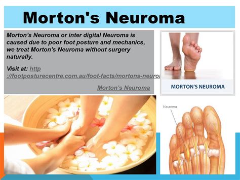 Morton's neuroma