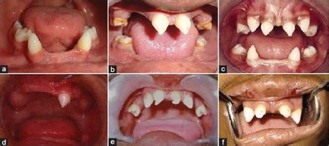 Ectodermal dysplasia causes, types, symptoms, diagnosis and treatment