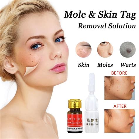 Dark Spot Removal Wart Tag Freckle Removal Oil Mole Skin Tag Removal ...