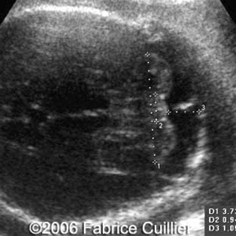 📃 Fetal valproate syndrome