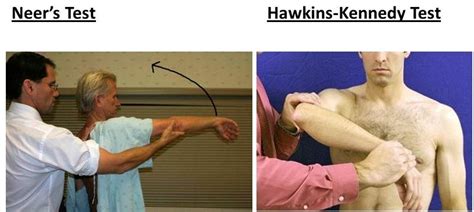 Hawkins Test Shoulder - fingersandfeathersh