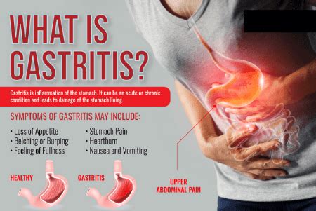 Naturopathy Treatment For Gastritis | Medintu