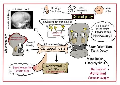 Osteopetrosis cartoons and illustrations - Creative Med Doses