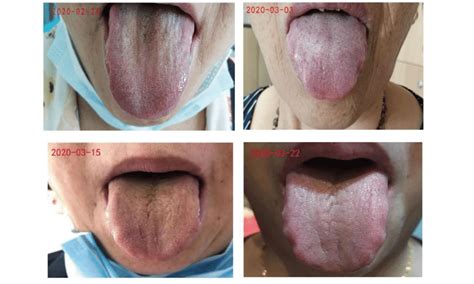 Changes of the patient's tongue image before and after treatment. The... | Download Scientific ...