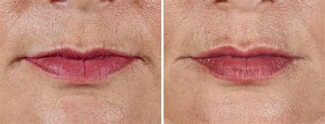 volbella before after lip lines Facial Fillers, Lip Fillers, Skin Care ...