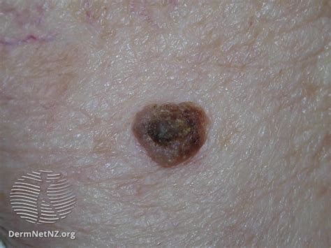 Irritated Seborrheic Keratosis