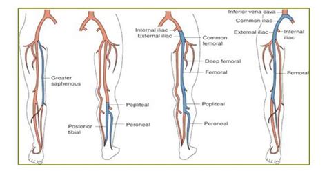 Superficial Venous Thrombophlebitis (SVT): To Refer or Not