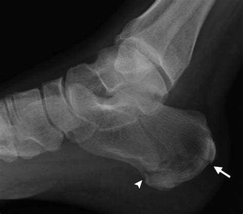 Multidetector CT Evaluation of Calcaneal Fractures | RadioGraphics