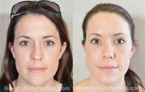 Facial Fat Transfer Before & After Photo Gallery