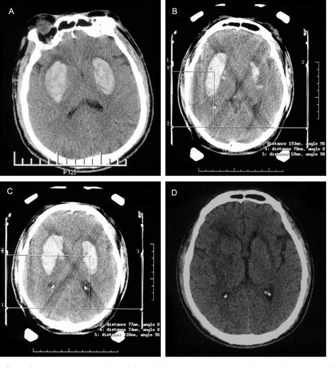 Simultaneous bilateral hypertensive basal ganglia hemorrhage. | Semantic Scholar