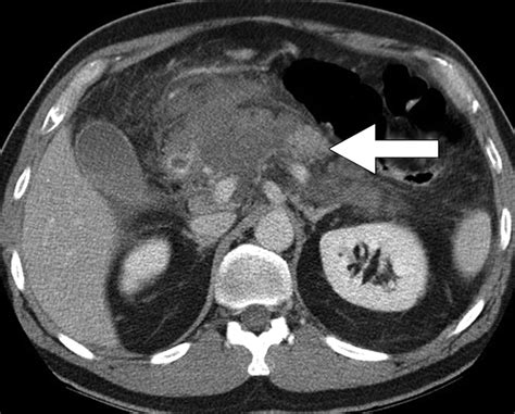 Imaging of Acute Pancreatitis | AJR