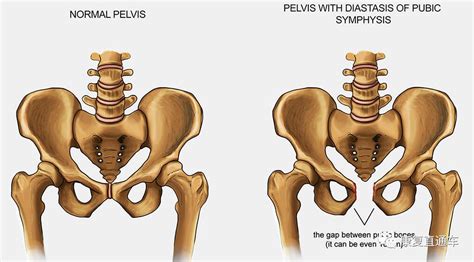 产后耻骨联合分离、耻骨疼痛的原因与康复方法