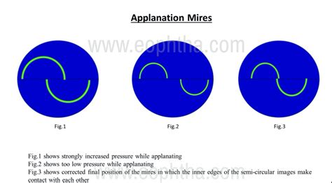 A Postgraduate's Guide To Tonometry