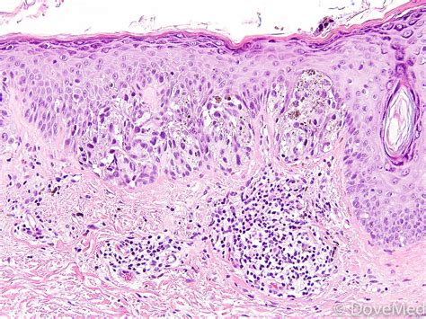 Melanoma In Situ of Skin