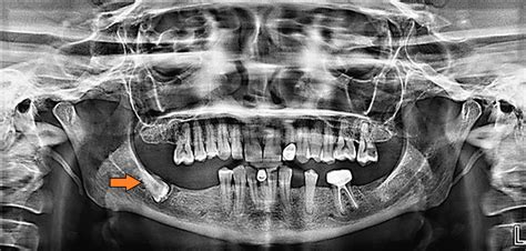 Bilateral Inverted and Impacted Mandibular Third Molars: A Rare Case Report | Cureus