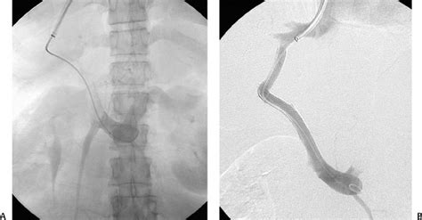 70 Biliary to Transjugular Intrahepatic Portosystemic Shunt (TIPS) Fistula | Radiology Key