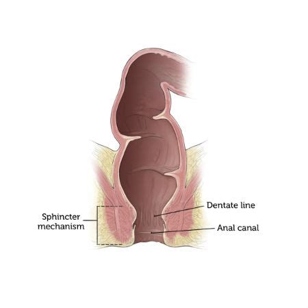 Pull-through Procedure for Hirschsprung's Disease | Boston Children's Hospital