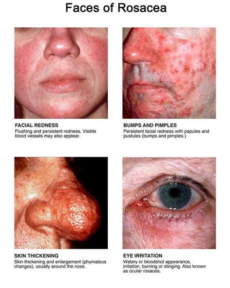 Rosacea Awareness - Skin Happy