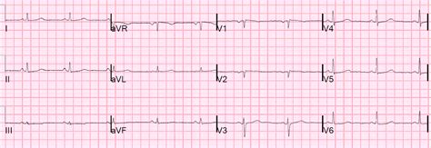 Dr. Smith's ECG Blog: Chest Pain and Q-waves in V1 and V2. Is there ...