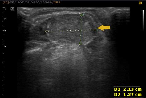 Graves’ disease and recurrence in ectopic thyroid tissue after total thyroidectomy | BMJ Case ...