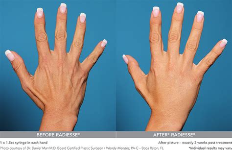 Radiesse | Darst Dermatology: Charlotte Dermatologist