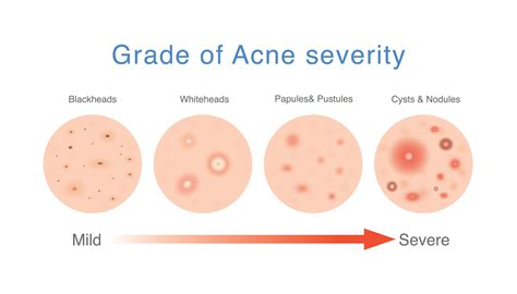 Isotrentinoïne (Accutane) gebruiken voor acne - Med NL