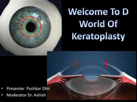 Penetrating keratoplasty by pushkar dhir