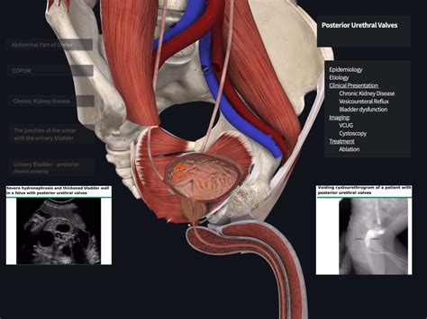 Male Urologic Disorders - Complete Anatomy