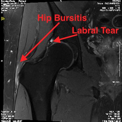 Trochanteric Bursitis – Knee and Hip Website