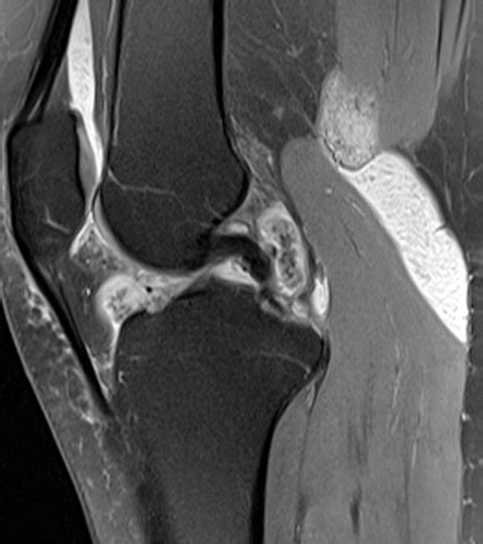 Primary Synovial Chondromatosis - Radsource