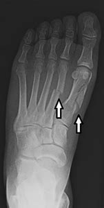 Metatarsal Fracture Orthopaedic Trauma Association Ota | Hot Sex Picture