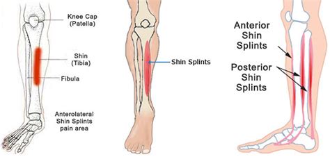 Shin Splints - Causes, Symptoms, How To Get Rid Of Shin Splints